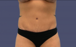 Abdominoplasty (Tummy Tuck) 12 After